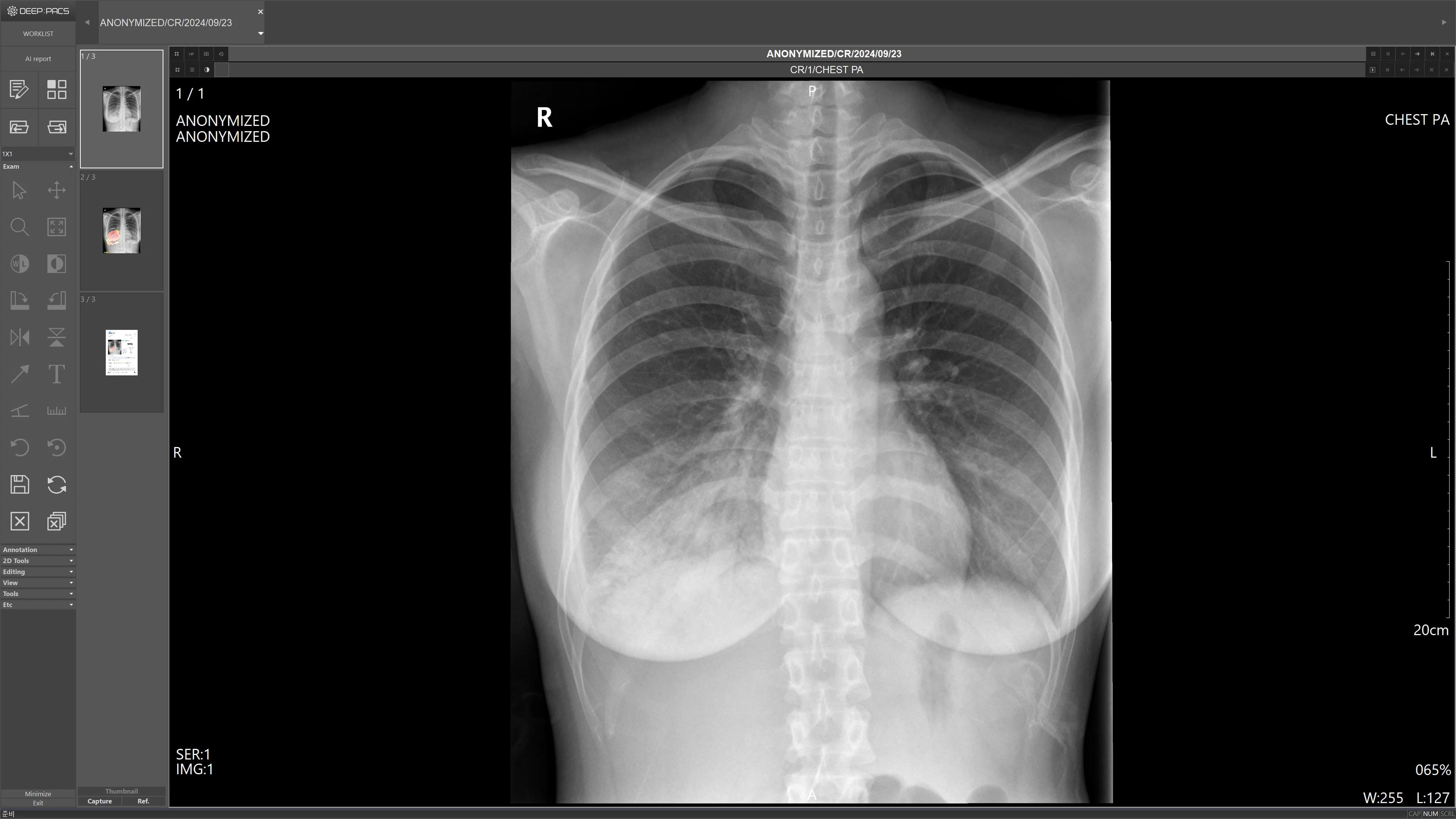 흉부 X-ray 원본
