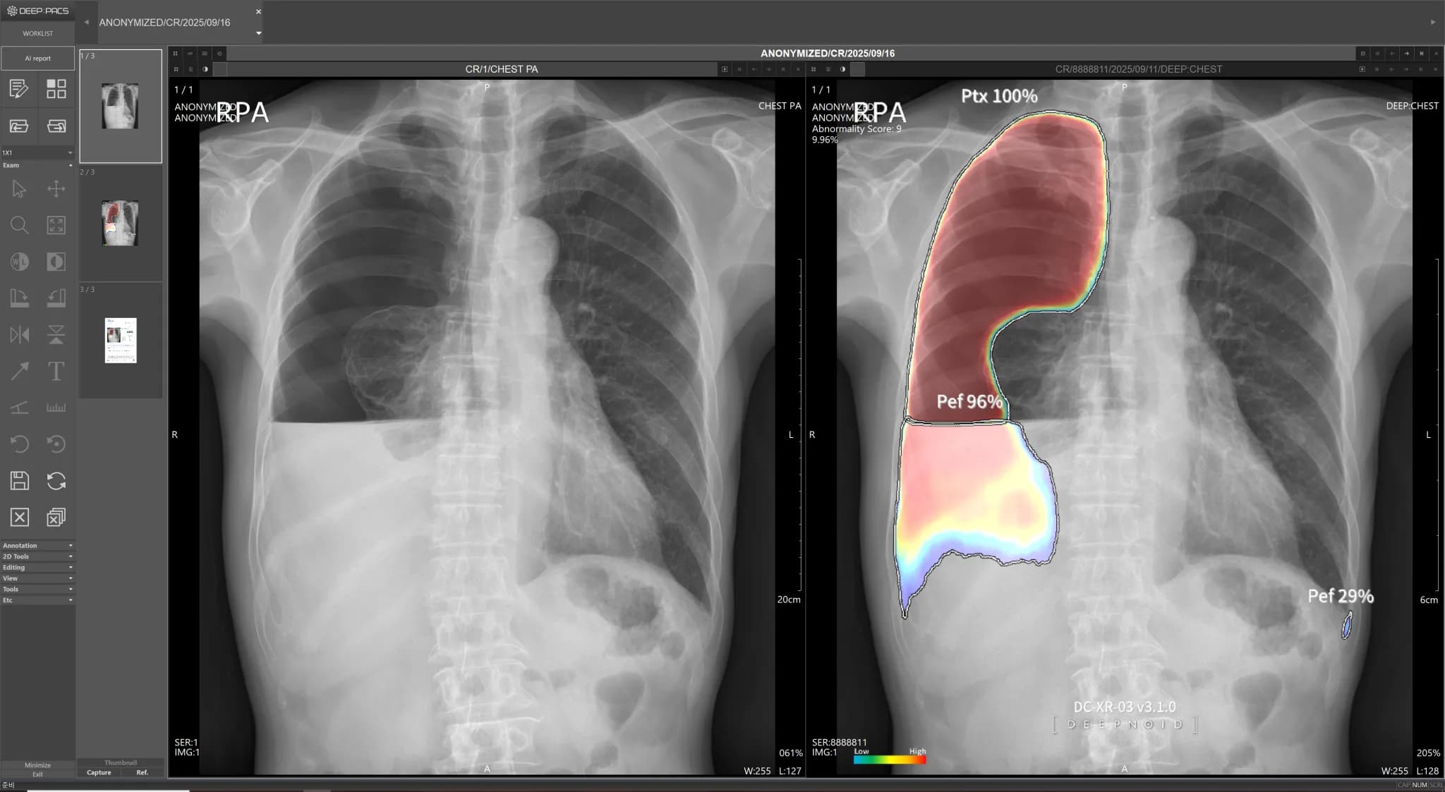 DEEP:CHEST Case 1