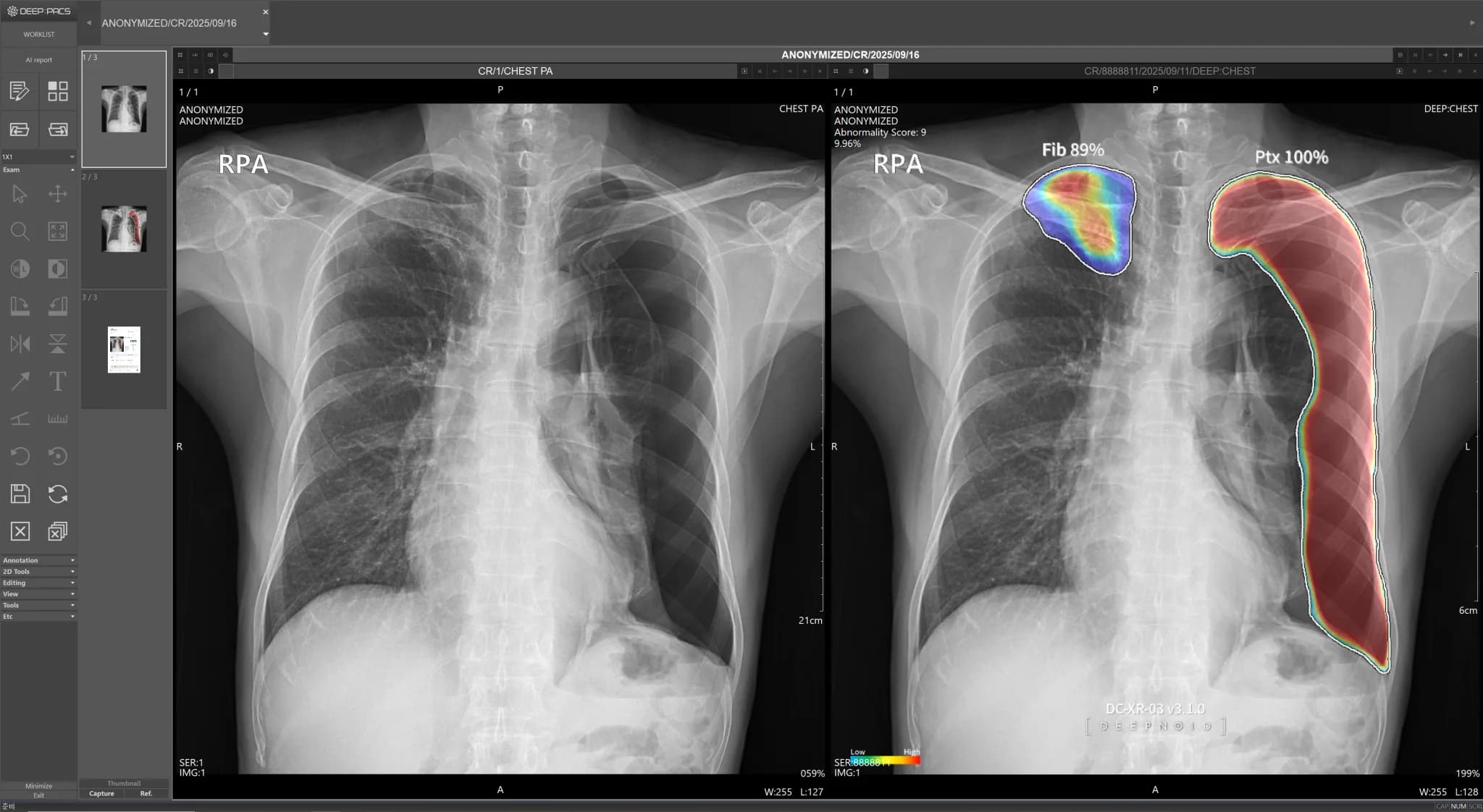 DEEP:CHEST Case 2