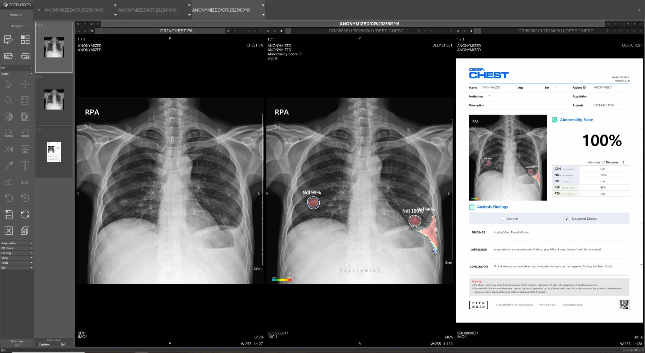 DEEP:CHEST Case 3