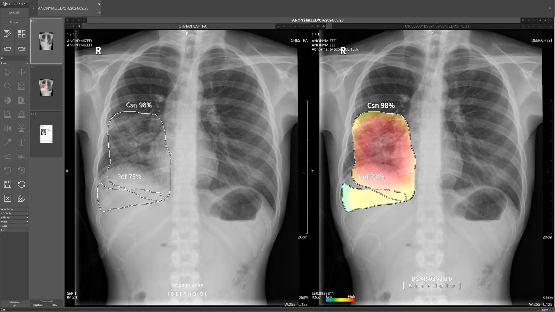 DEEP:CHEST Case 4