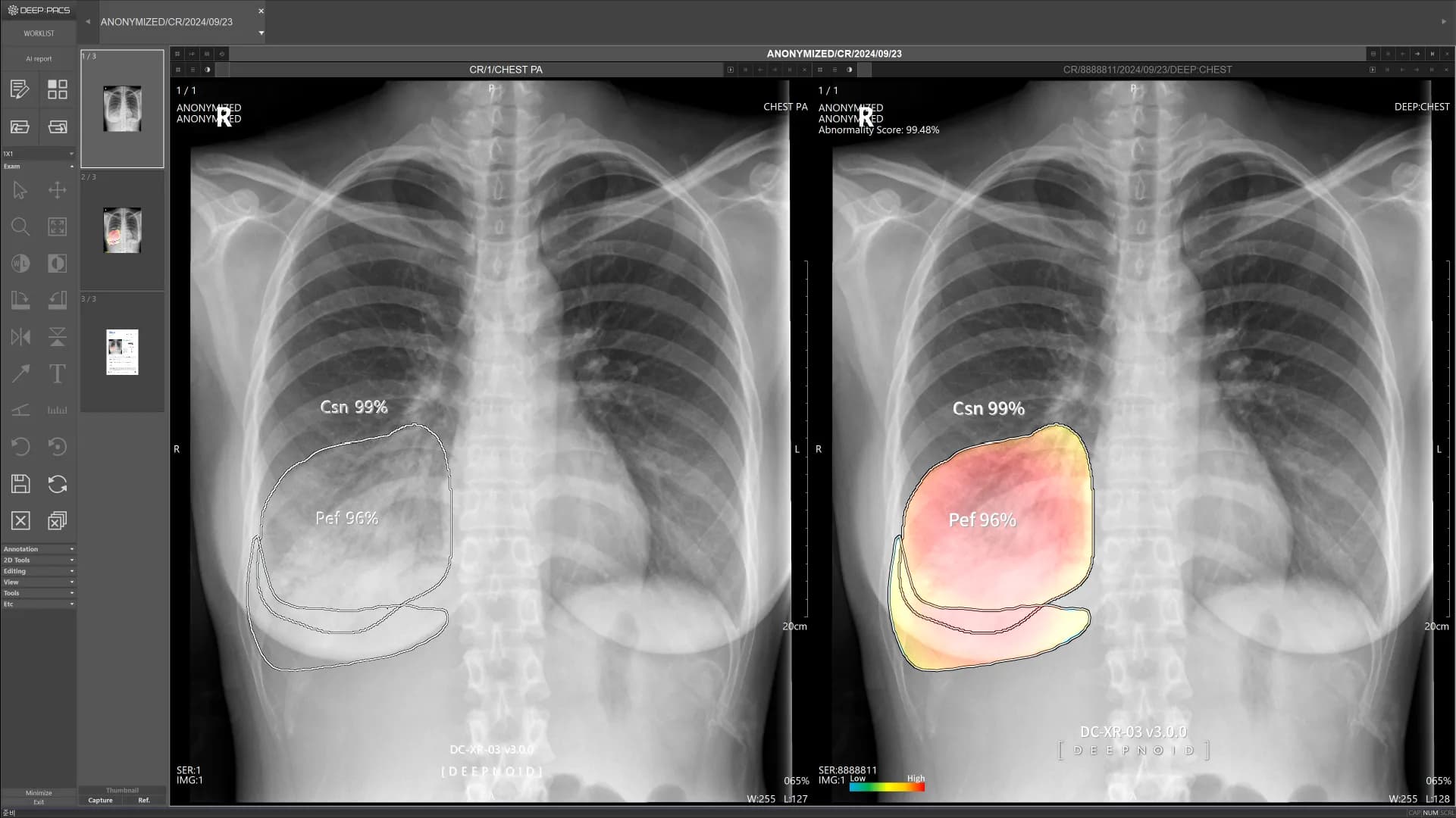 DEEP:CHEST Case 5