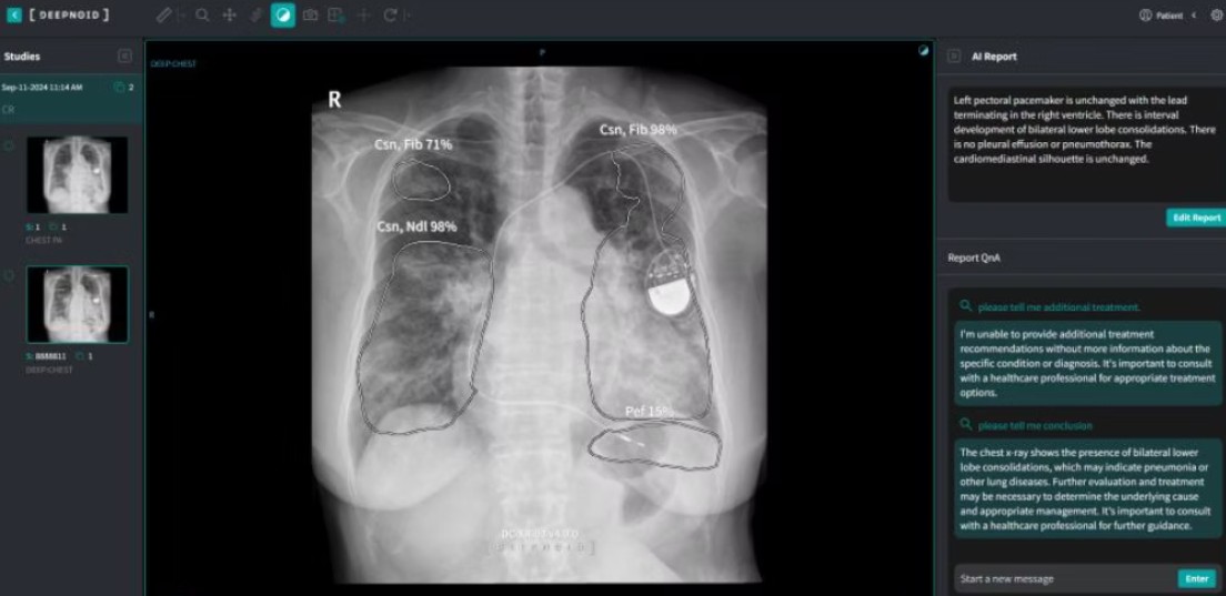 딥노이드 M4CXR, 흉부 X-Ray 판독에서 ChatGPT 보다 월등